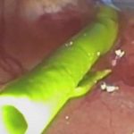 پیوند شگفت‌انگیز آهن و انسولین؛ روزنه‌ای تازه برای محافظت از لوزالمعده