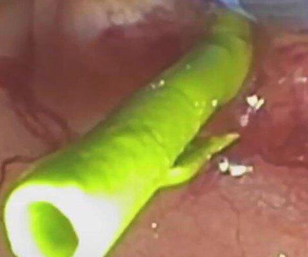 پیوند شگفت‌انگیز آهن و انسولین؛ روزنه‌ای تازه برای محافظت از لوزالمعده